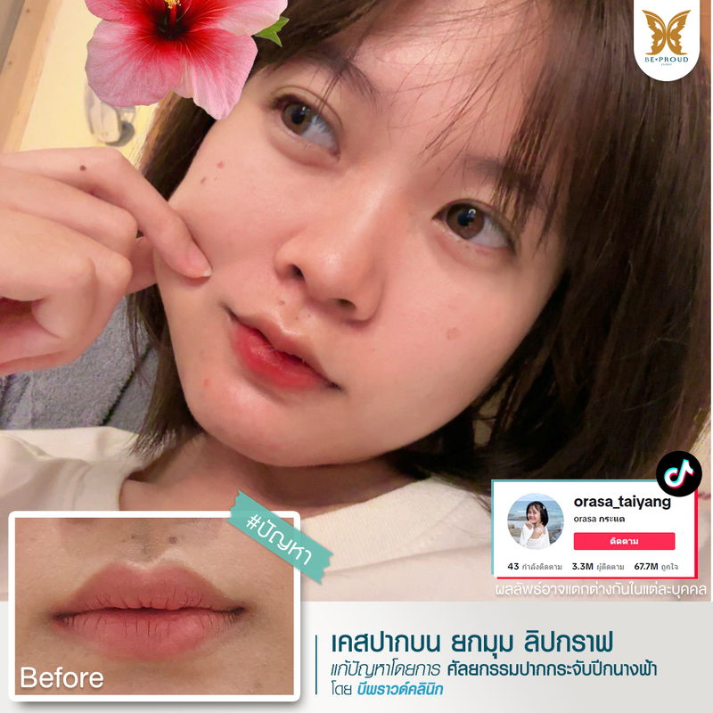 ผลลัพธ์หลังทำทำปากกระจับปีกนางฟ้า ที่ Beproud Clinic รูป 4