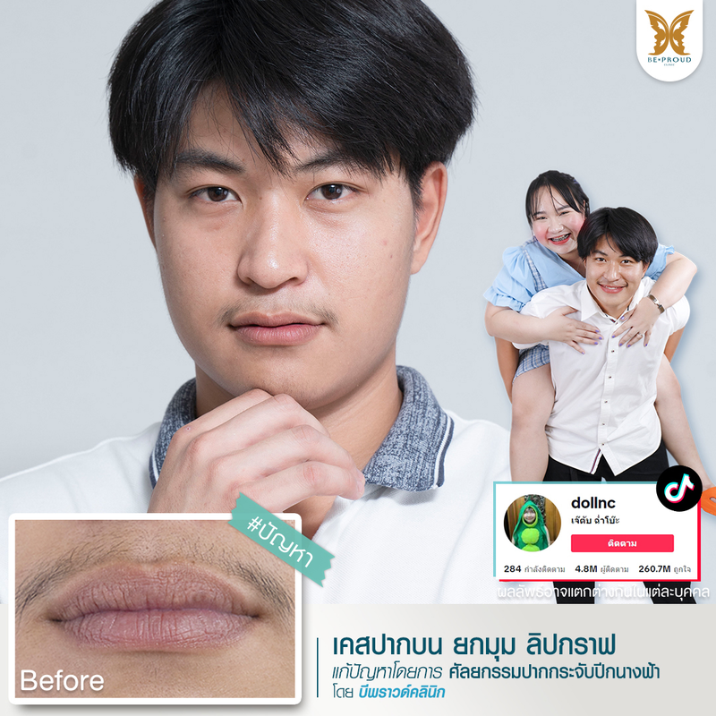 ผลลัพธ์หลังทำทำปากกระจับปีกนางฟ้า ที่ Beproud Clinic รูป 5