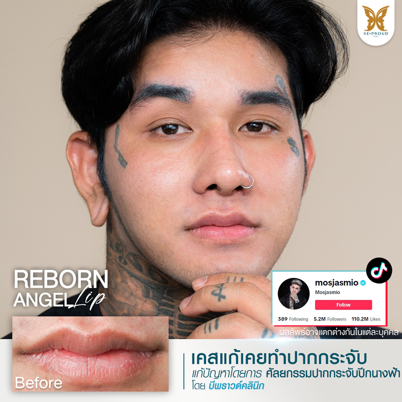 ผลลัพธ์หลังทำทำปากกระจับปีกนางฟ้า ที่ Beproud Clinic รูป 6