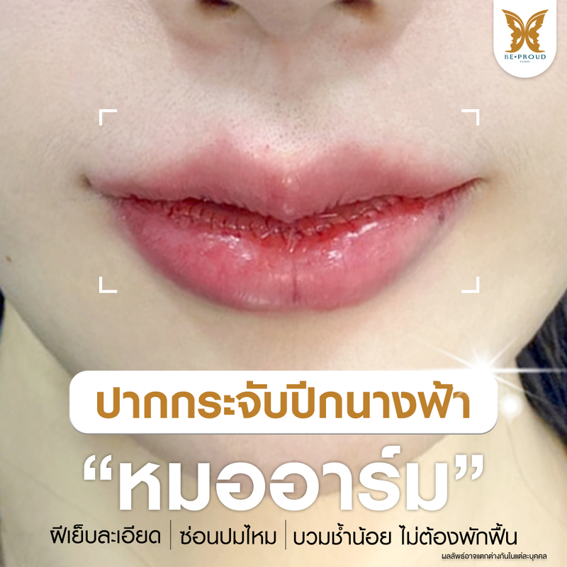 ทำปากกระจับปีกนางฟ้า หมออาร์ม ที่ Beproud Clinic