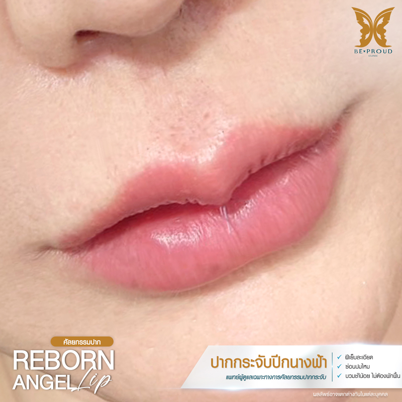 ผลลัพธ์หลังทำทำปากกระจับปีกนางฟ้า ที่ Beproud Clinic รูป 11