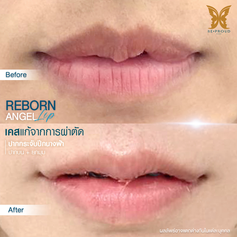 ผลลัพธ์หลังทำทำปากกระจับปีกนางฟ้า ที่ Beproud Clinic รูป 7