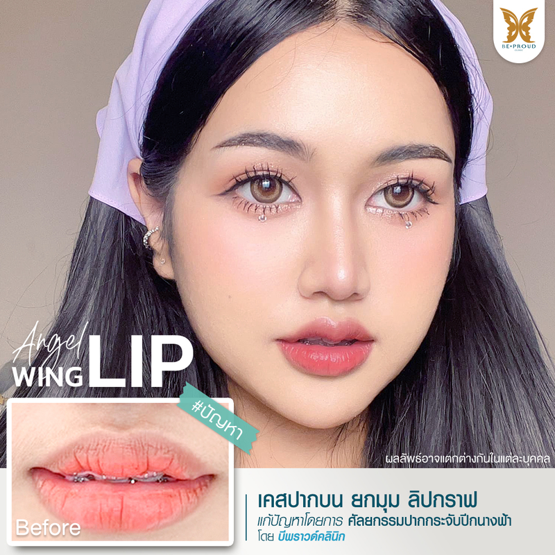 ผลลัพธ์หลังทำทำปากกระจับปีกนางฟ้า ที่ Beproud Clinic รูป 1