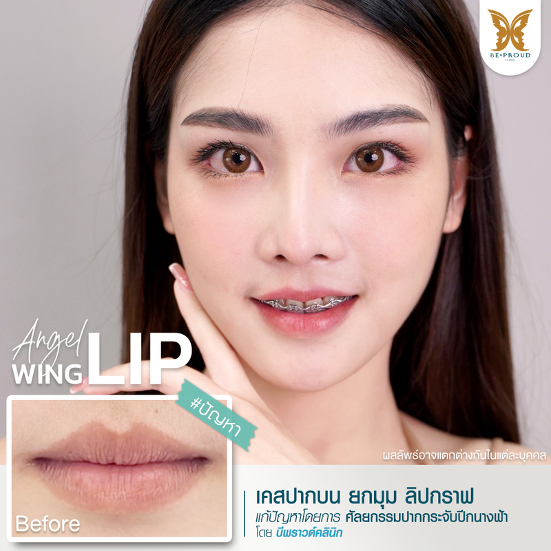 ผลลัพธ์หลังทำทำปากกระจับปีกนางฟ้า ที่ Beproud Clinic รูป 2