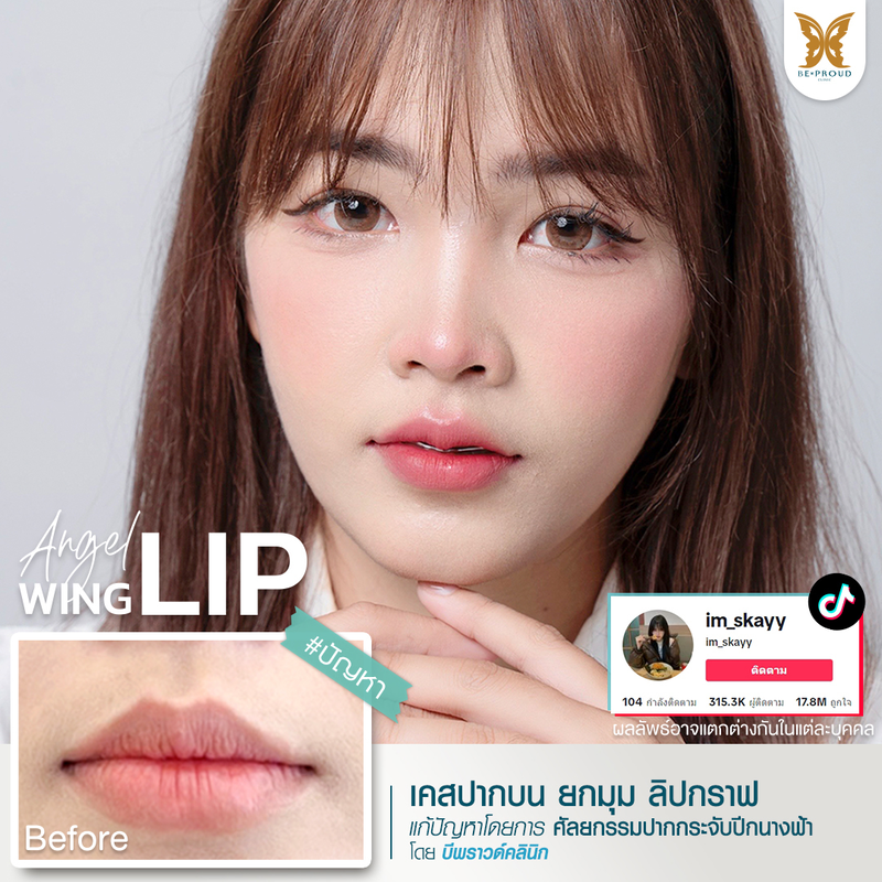 ผลลัพธ์หลังทำทำปากกระจับปีกนางฟ้า ที่ Beproud Clinic รูป 3