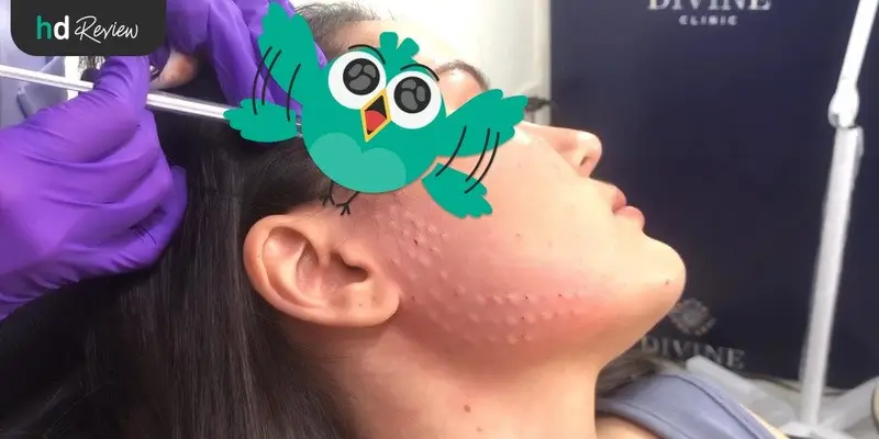 รีวิวฉีด Botulinum Toxin Signature Divine Lift ที่ Divine Clinic