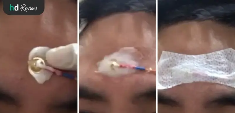 ขั้นตอนการติดตั้งอุปกรณ์เพื่อตรวจการนอนหลับ