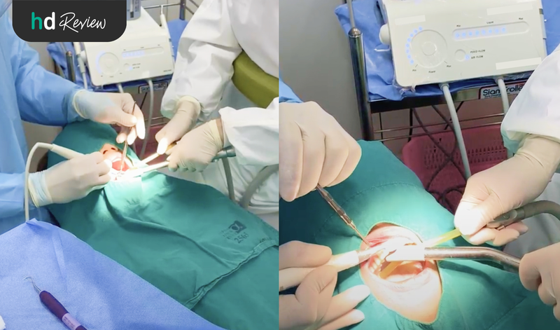 ขั้นตอนการขูดหินปูน