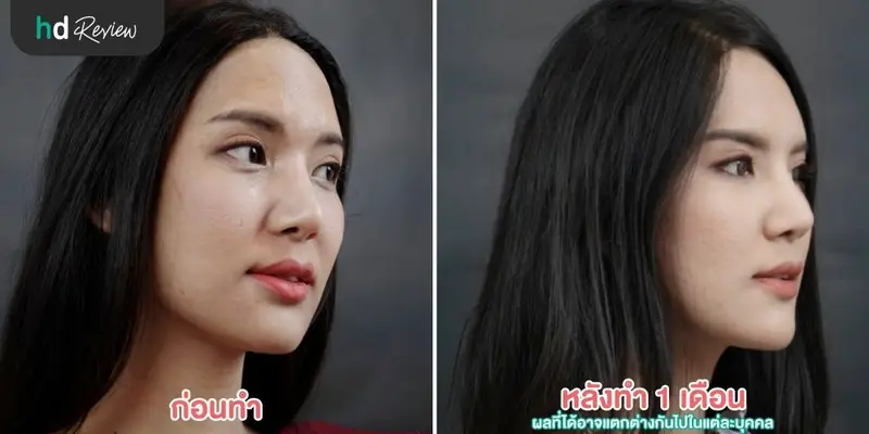 รีวิว รักษาหลุมสิวด้วย PicoWay ที่ The Sign Clinic