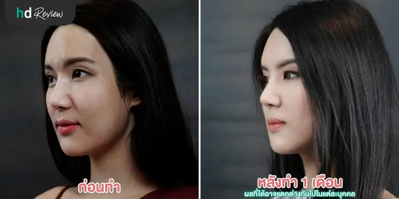 รีวิว รักษาหลุมสิวด้วย PicoWay ที่ The Sign Clinic