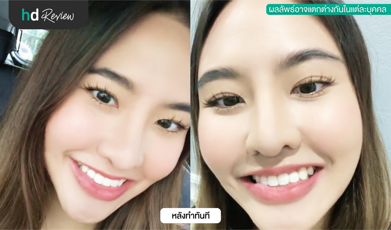 ฟอกสีฟันด้วยระบบ Cool light ดีไหม?