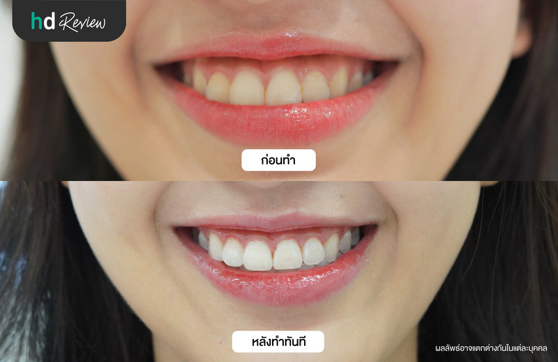 ผลลัพธ์หลังฟอกสีฟันแบบ Zoom