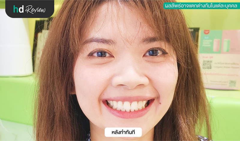 ผลลัพธ์หลังฟอกสีฟันด้วยระบบ Cool light