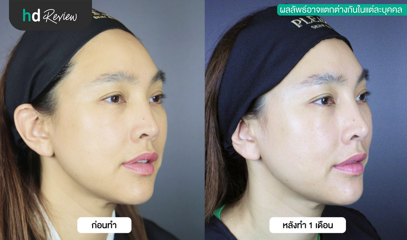ผลลัพธ์หลังทำ Ultherapy SPT ครบ 1 เดือน