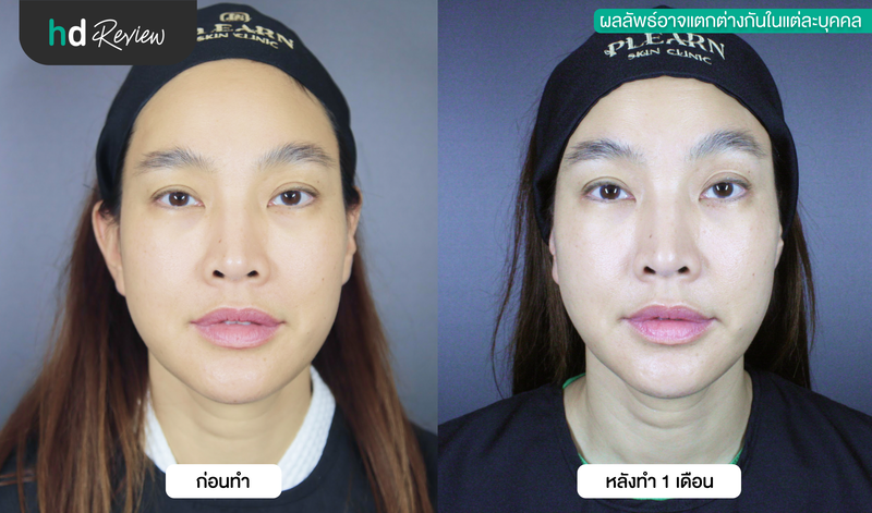 ผลลัพธ์หลังทำ Ultherapy SPT