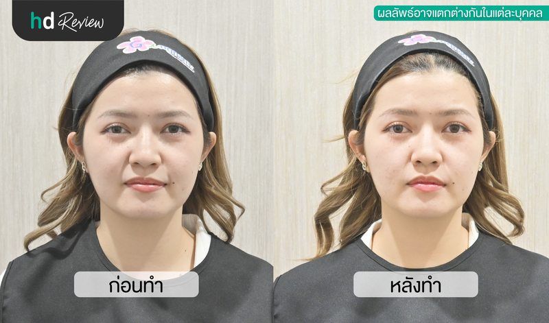 ภาพเปรียบเทียบผลลัพธ์ก่อนและหลังทำ HIFU Plus ทันที