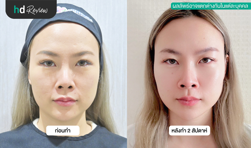 รีวิว โปรแกรม HIFU Plus