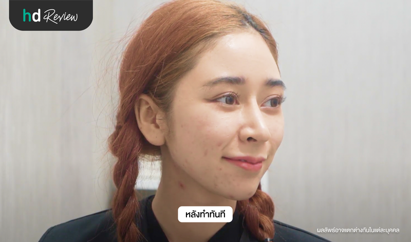 ผลลัพธ์หลังยกกระชับหน้าด้วย Hifu Plus ทันที