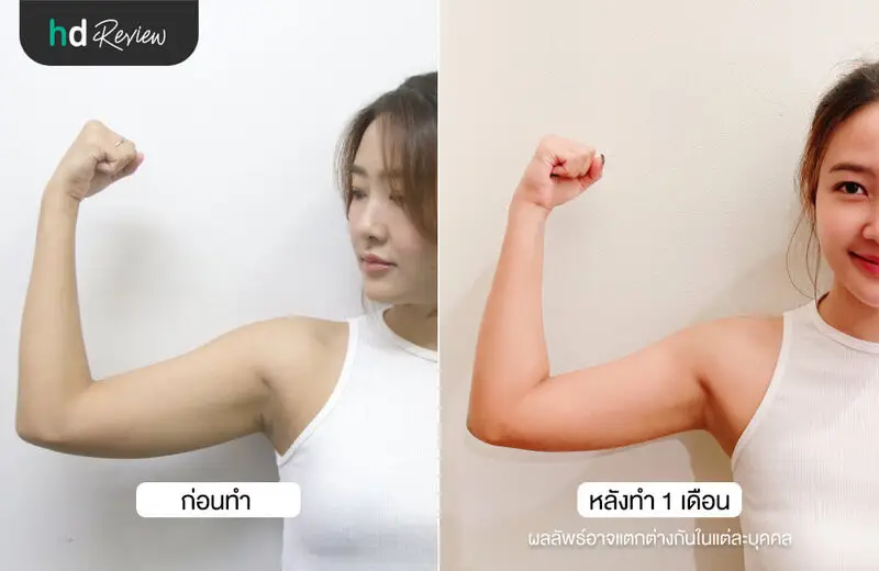 เปรียบเทียบก่อนและหลังดูดไขมันต้นแขน ด้วยเครื่อง Vaser Liposuction ที่ Flow Clinic