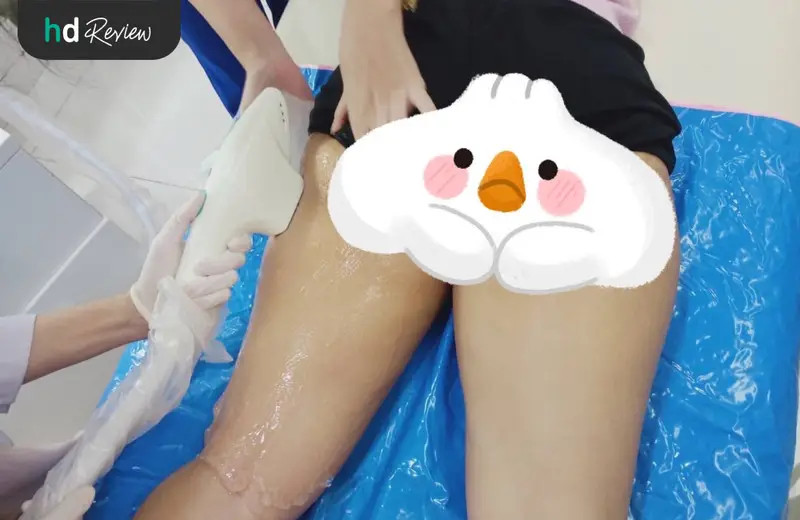 รีวิว กำจัดขนขาด้วย IPL ที่ Villa Clinic
