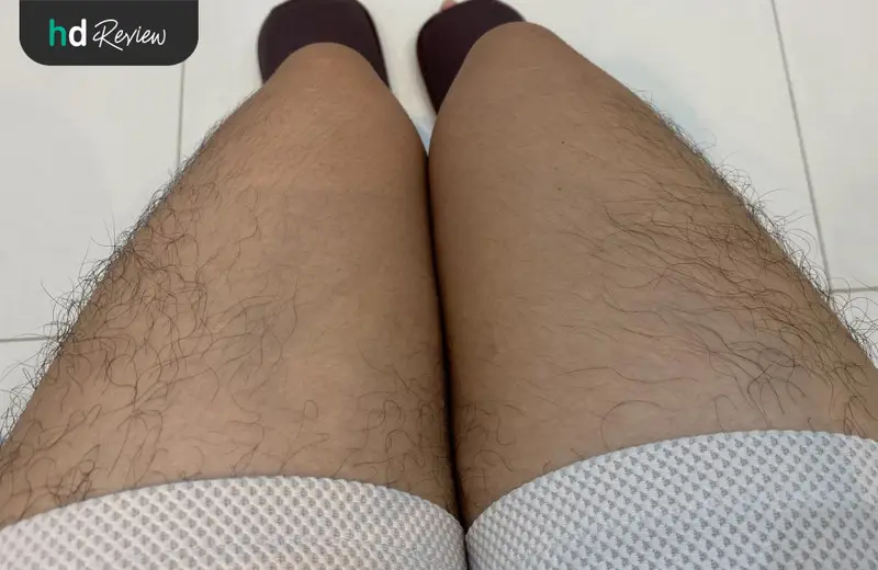 รีวิว กำจัดขนขาด้วย IPL ที่ Villa Clinic
