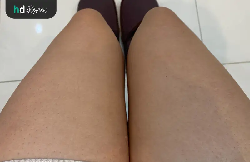 รีวิว กำจัดขนขาด้วย IPL ที่ Villa Clinic