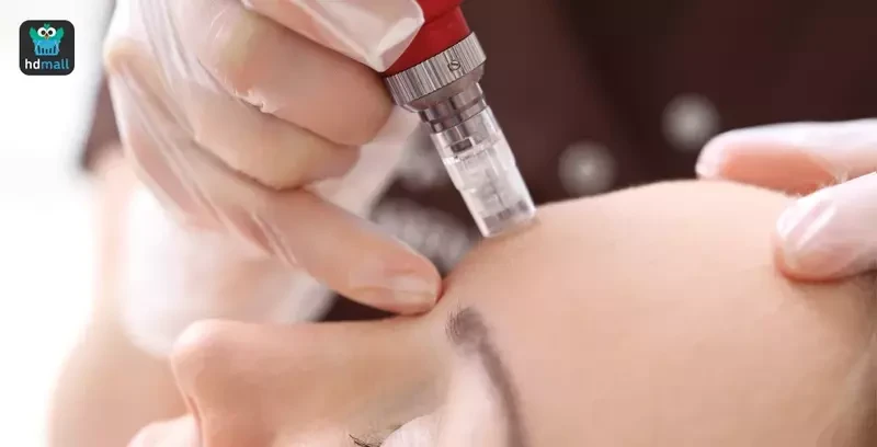 รักษาหลุมสิวด้วยการใช้ Skin Needling