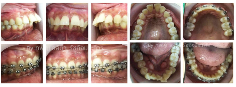 จัดฟันแบบดามอน (Damon System) และสมาร์ตคลิป (Smart Clip) ที่ คลินิกฟันยิ้มราม 2