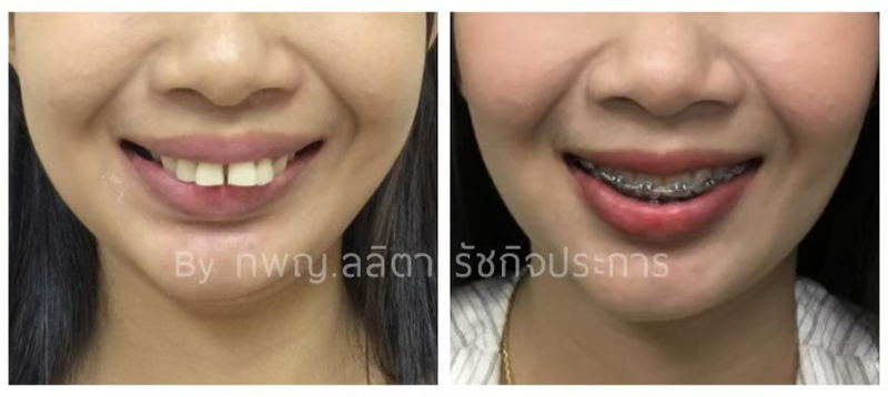 จัดฟันแบบดามอน (Damon System) และสมาร์ตคลิป (Smart Clip) ที่ คลินิกฟันยิ้มราม 2