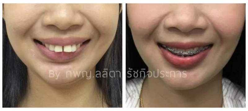 จัดฟันแบบดามอน (Damon System) และสมาร์ตคลิป (Smart Clip) ที่ คลินิกฟันยิ้มราม 2