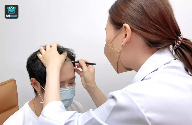 ขั้นตอนการปลูกผมแบบ FUE ที่ Flow Clinic