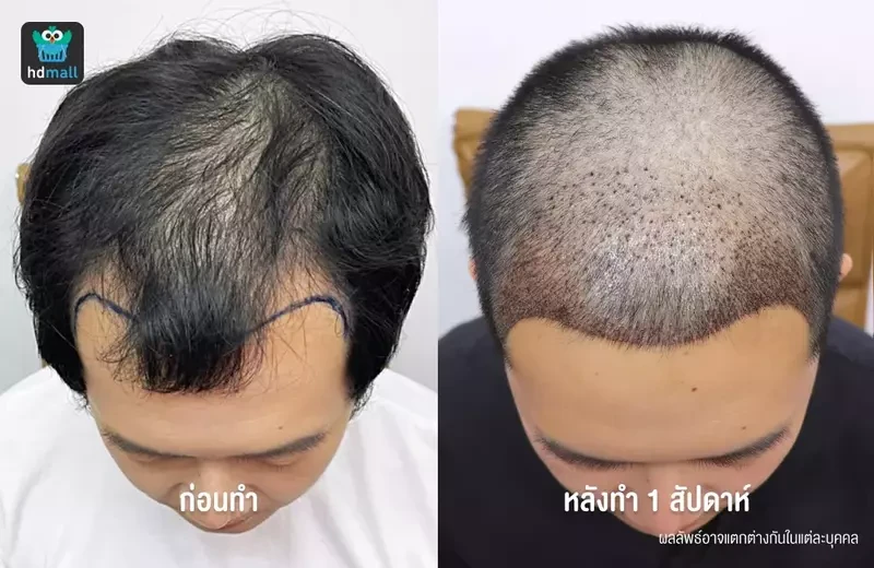 ปลูกผมแบบ FUE จะเริ่มเห็นผลลัพธ์ตอนไหน?