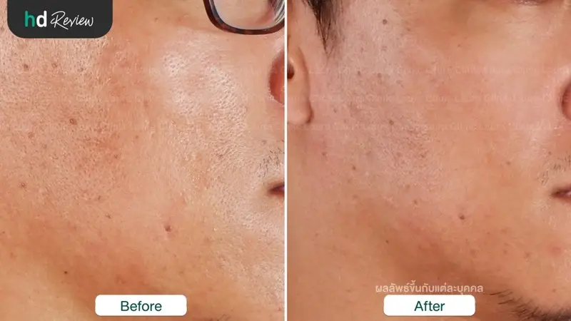 รีวิวรักษาหลุมสิวด้วยเครื่อง E-matrix ที่ Laura Clinic