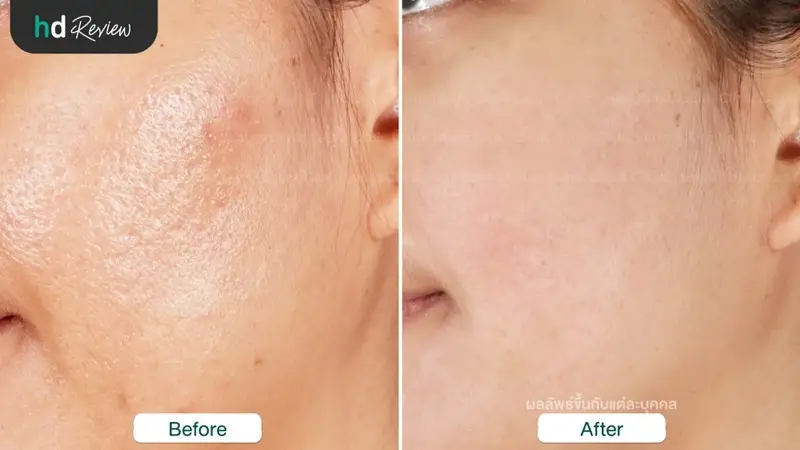รีวิวรักษาหลุมสิวด้วยเครื่อง E-matrix ที่ Laura Clinic