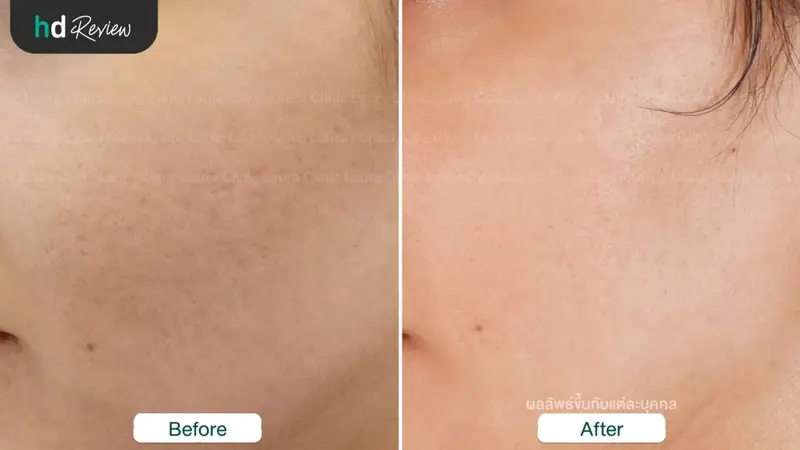 รีวิวรักษาหลุมสิวด้วยเครื่อง E-matrix ที่ Laura Clinic