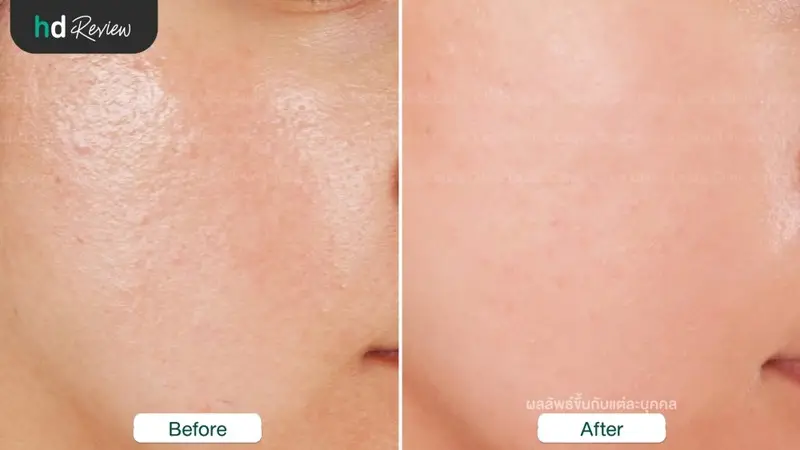รีวิวรักษาหลุมสิวด้วยเครื่อง E-matrix ที่ Laura Clinic