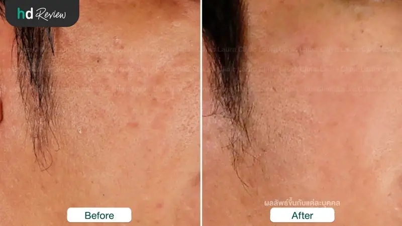 รีวิวรักษาหลุมสิวด้วยเครื่อง E-matrix ที่ Laura Clinic