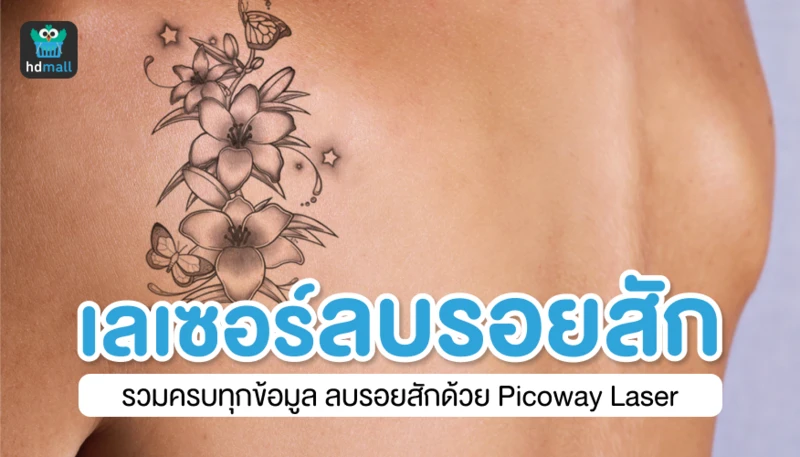 เลเซอร์ลบรอยสัก รวมครบทุกข้อมูลลบรอยสักด้วย Picoway Laser