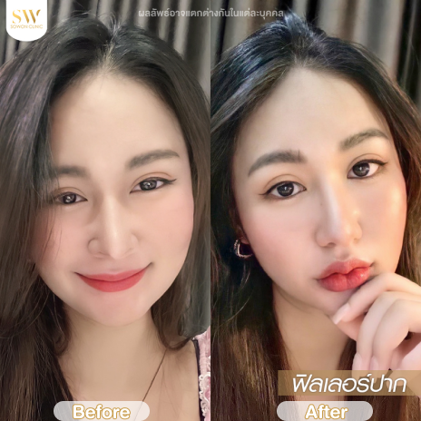 รีวิวฉีดฟิลเลอร์ปากที่ Sowon Clinic รูปที่ 3