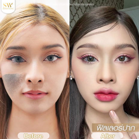 รีวิวฉีดฟิลเลอร์ปากที่ Sowon Clinic รูปที่ 4