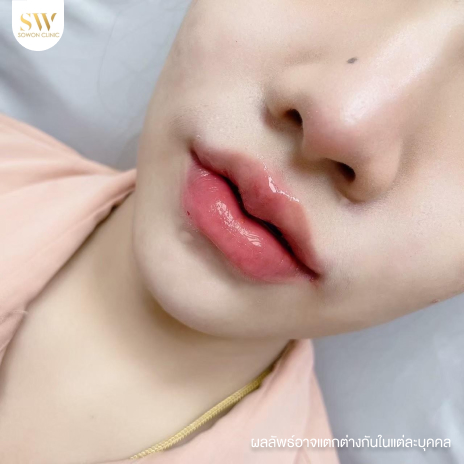 รีวิวฉีดฟิลเลอร์ปากที่ Sowon Clinic รูปที่ 9