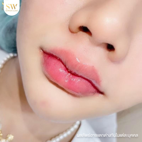 รีวิวฉีดฟิลเลอร์ปากที่ Sowon Clinic รูปที่ 11