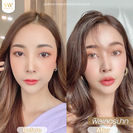 รีวิวฉีดฟิลเลอร์ปากที่ Sowon Clinic รูปที่ 1