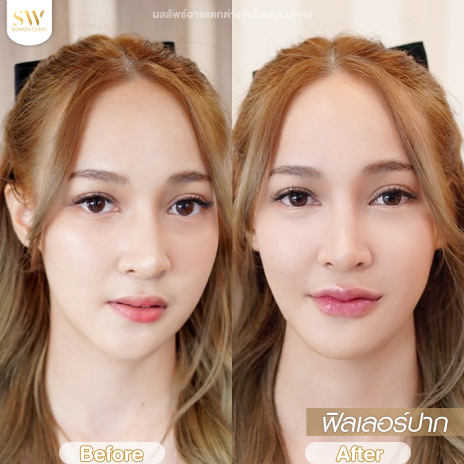 รีวิวฉีดฟิลเลอร์ปากที่ Sowon Clinic รูปที่ 2