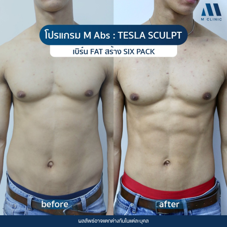 รีวิวสร้างซิกแพ็ก M Abs : Tesla Sculpt ที่ M Clinic