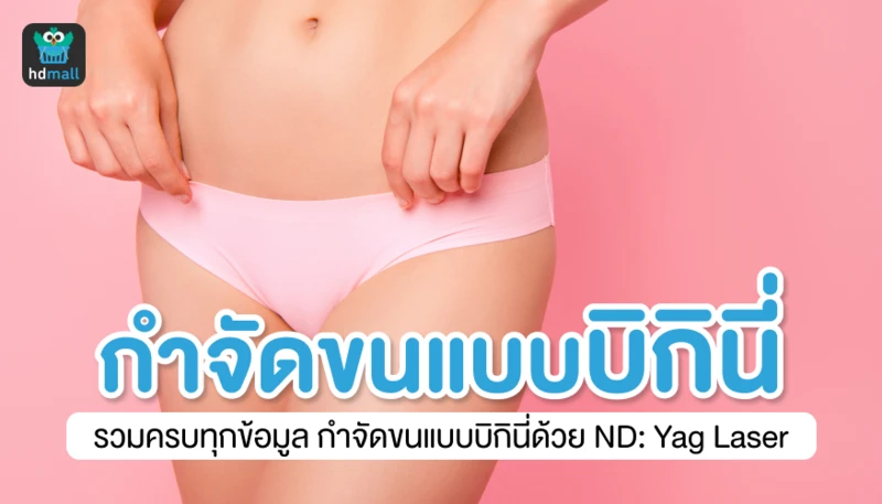 เลเซอร์กำจัดขนแบบบิกินี่ รวมครบทุกข้อมูล กำจัดขนบิกินี่ด้วย Nd:YAG Laser