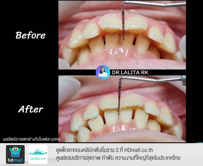 หลังใส่ Biomator 4 เดือน