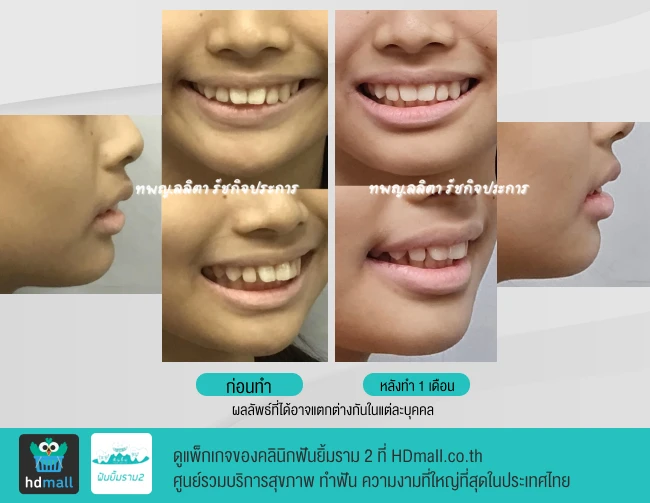 รีวิวใช้อุปกรณ์ช่วยไกด์ขากรรไกรล่าง (Bionator) 1