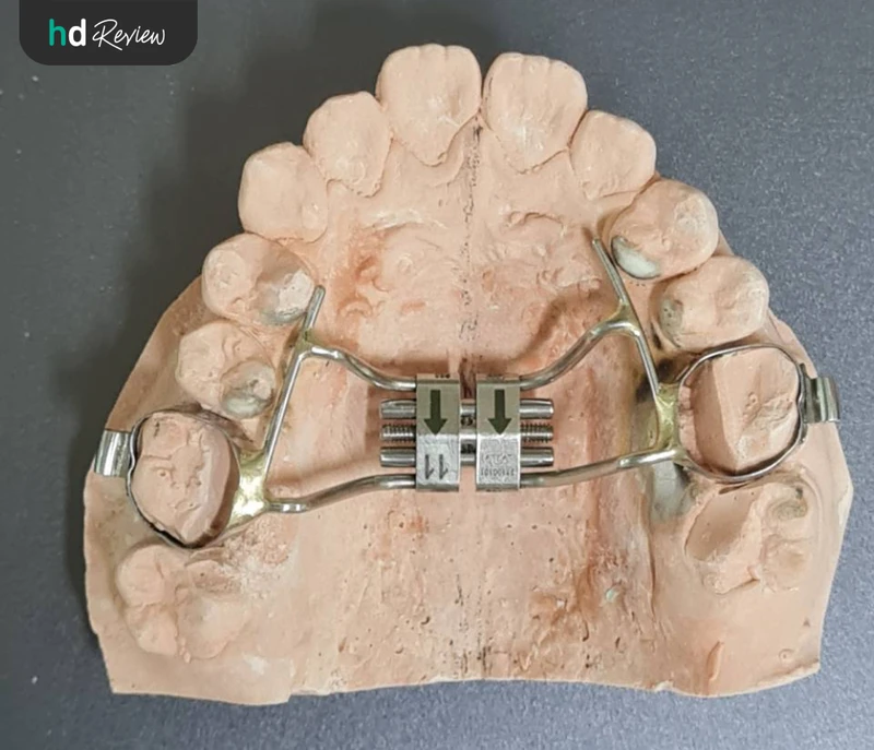 อุปกรณ์ขยายขากรรไกร (Expander)