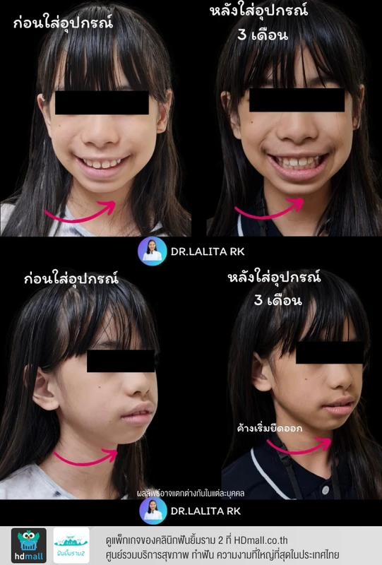 รีวิวใช้อุปกรณ์ช่วยไกด์ขากรรไกรล่าง (Bionator) 2